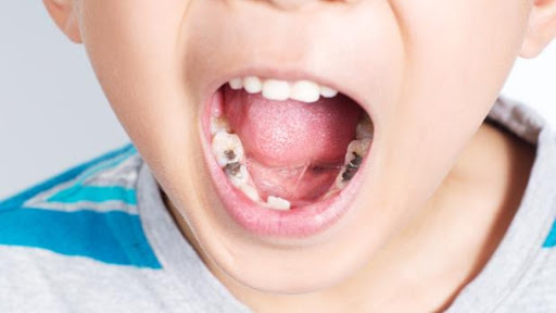 caries-infantil