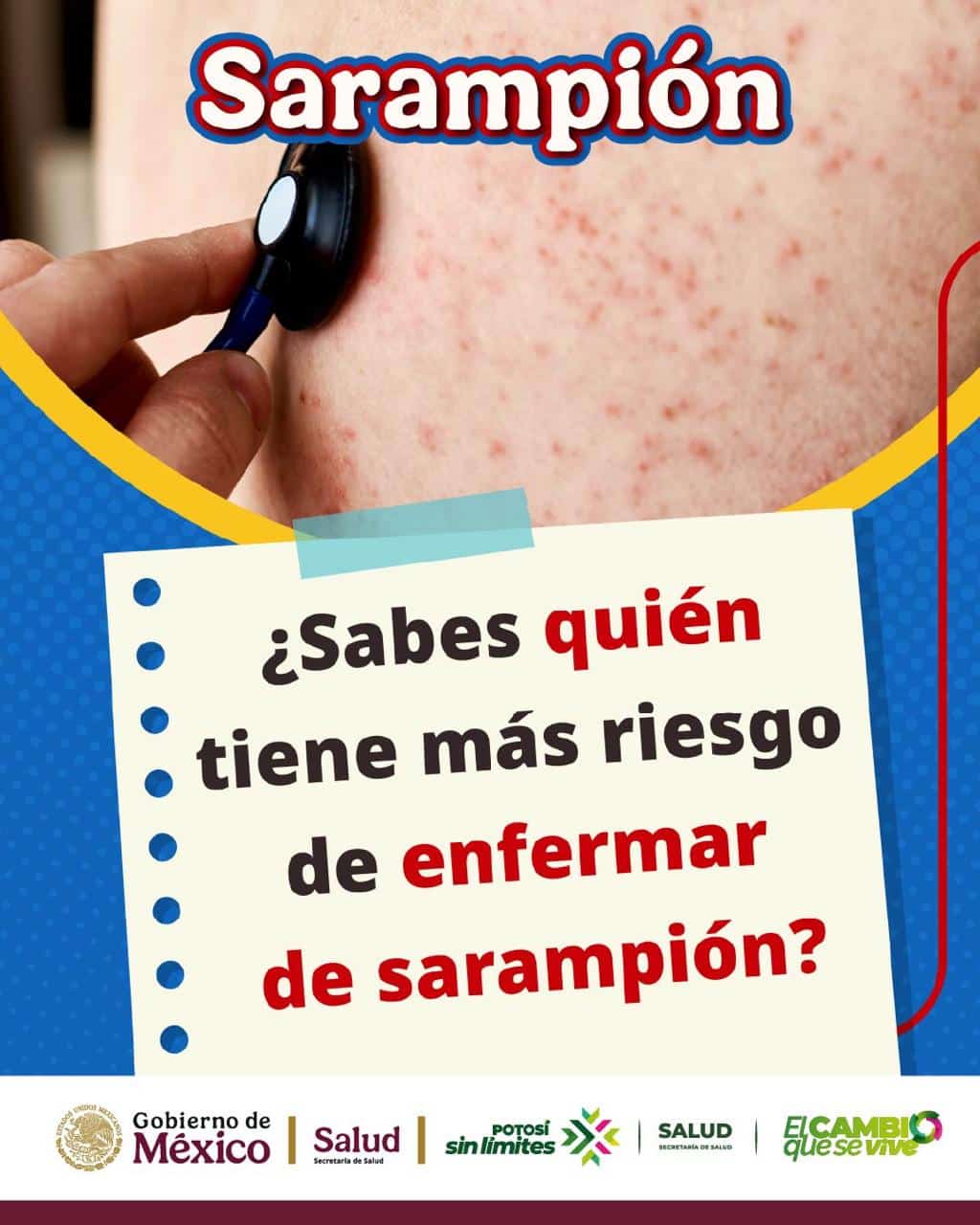 sarampión