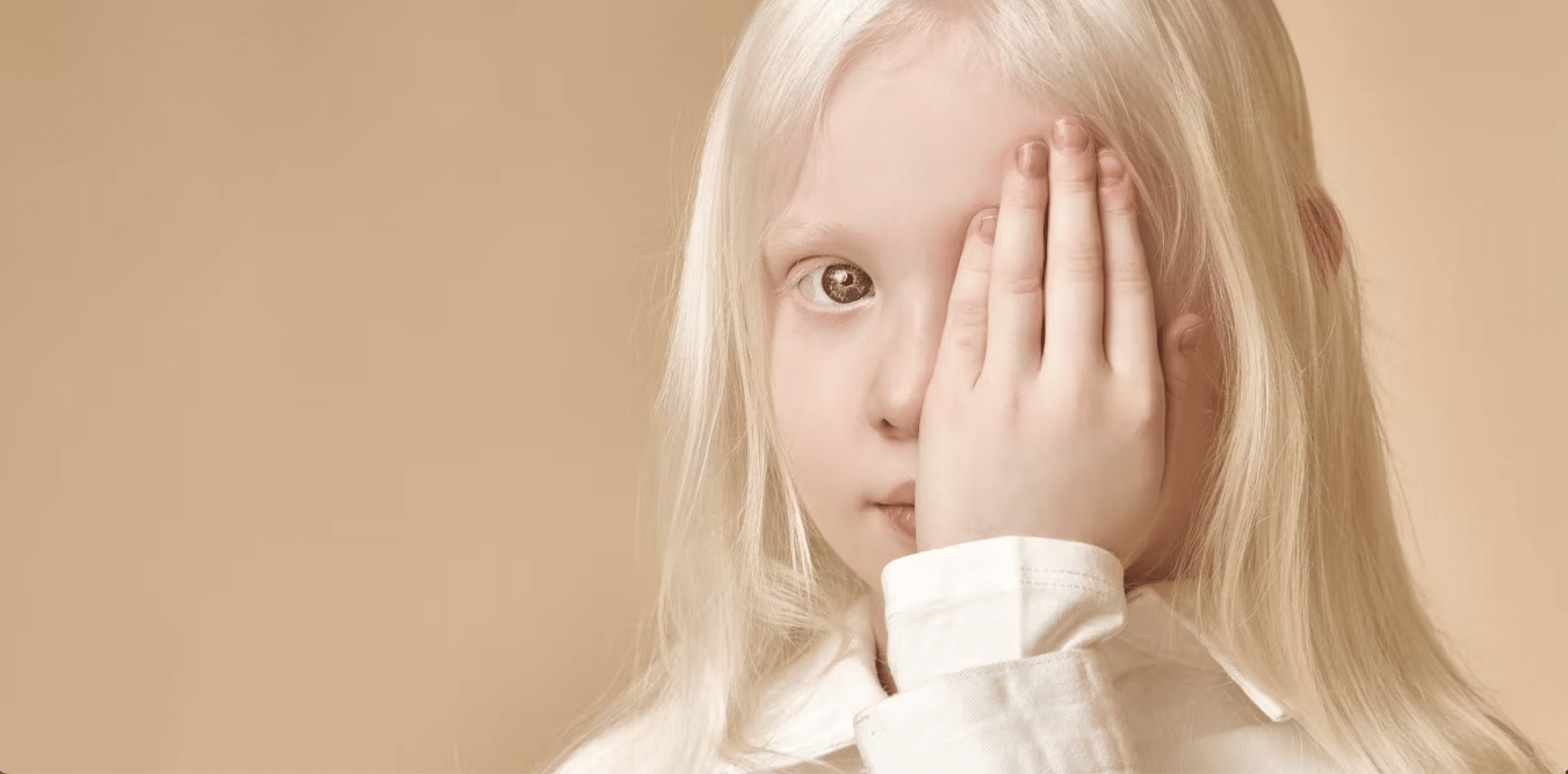 ¿Qué es el albinismo?