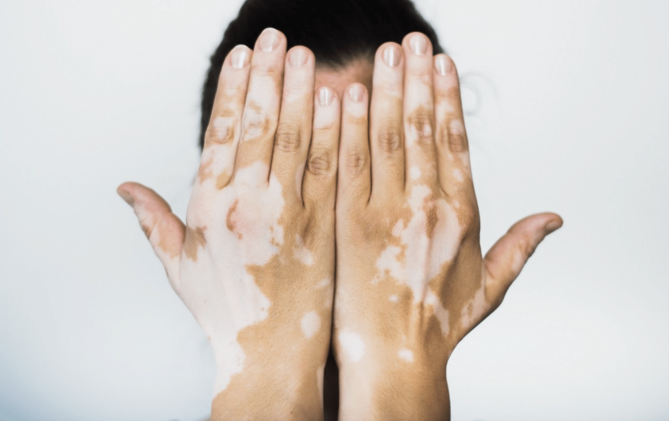 vitiligo