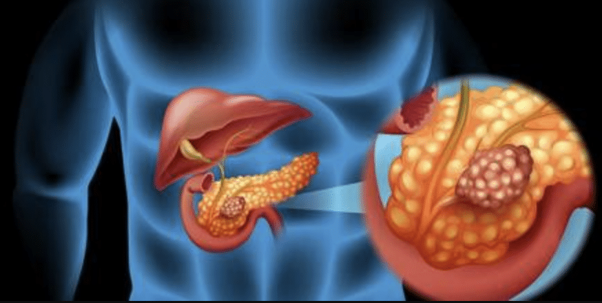 lucha contra cancer pancreas