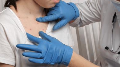 sarampión enferemedades salud vida sana