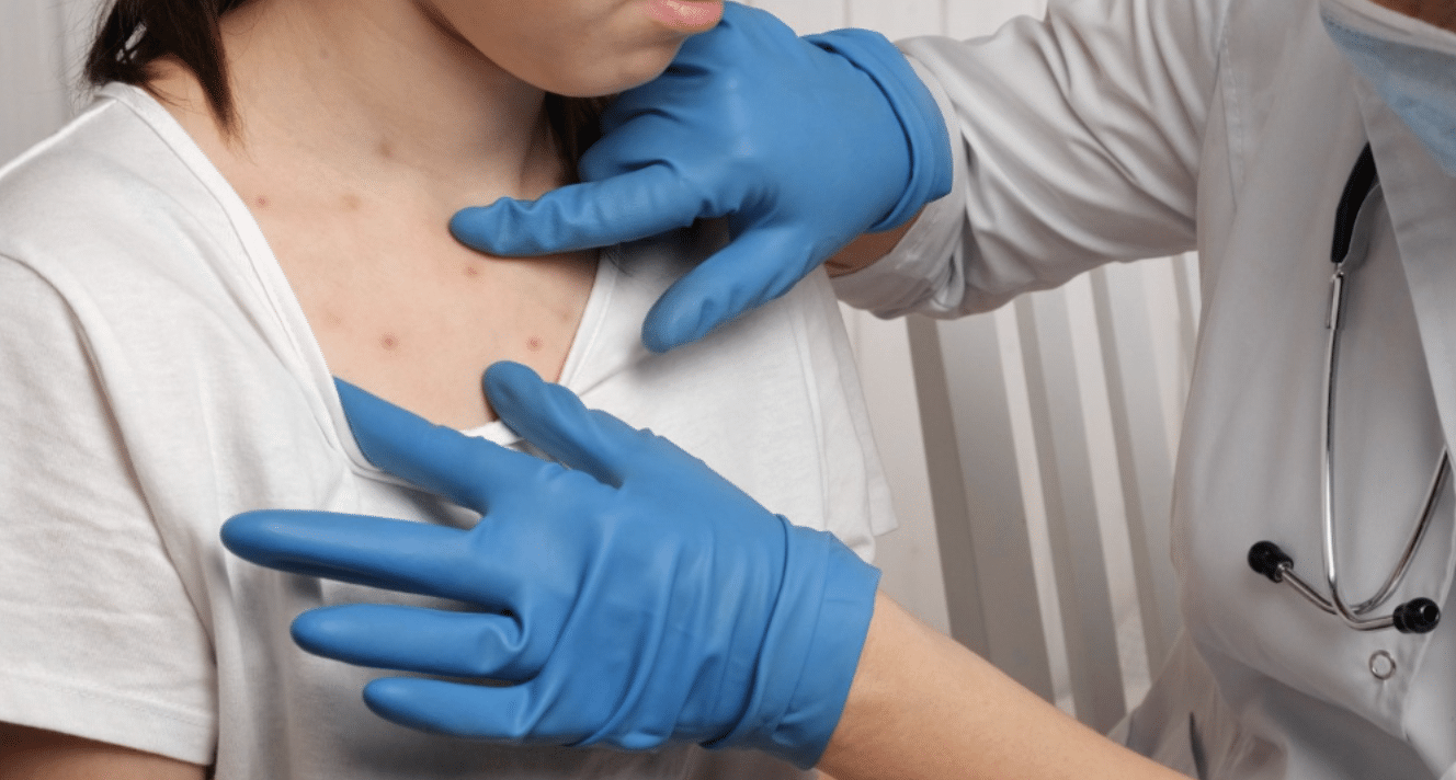 sarampión enferemedades salud vida sana