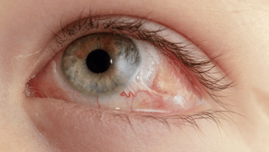 desprendimiento de retina