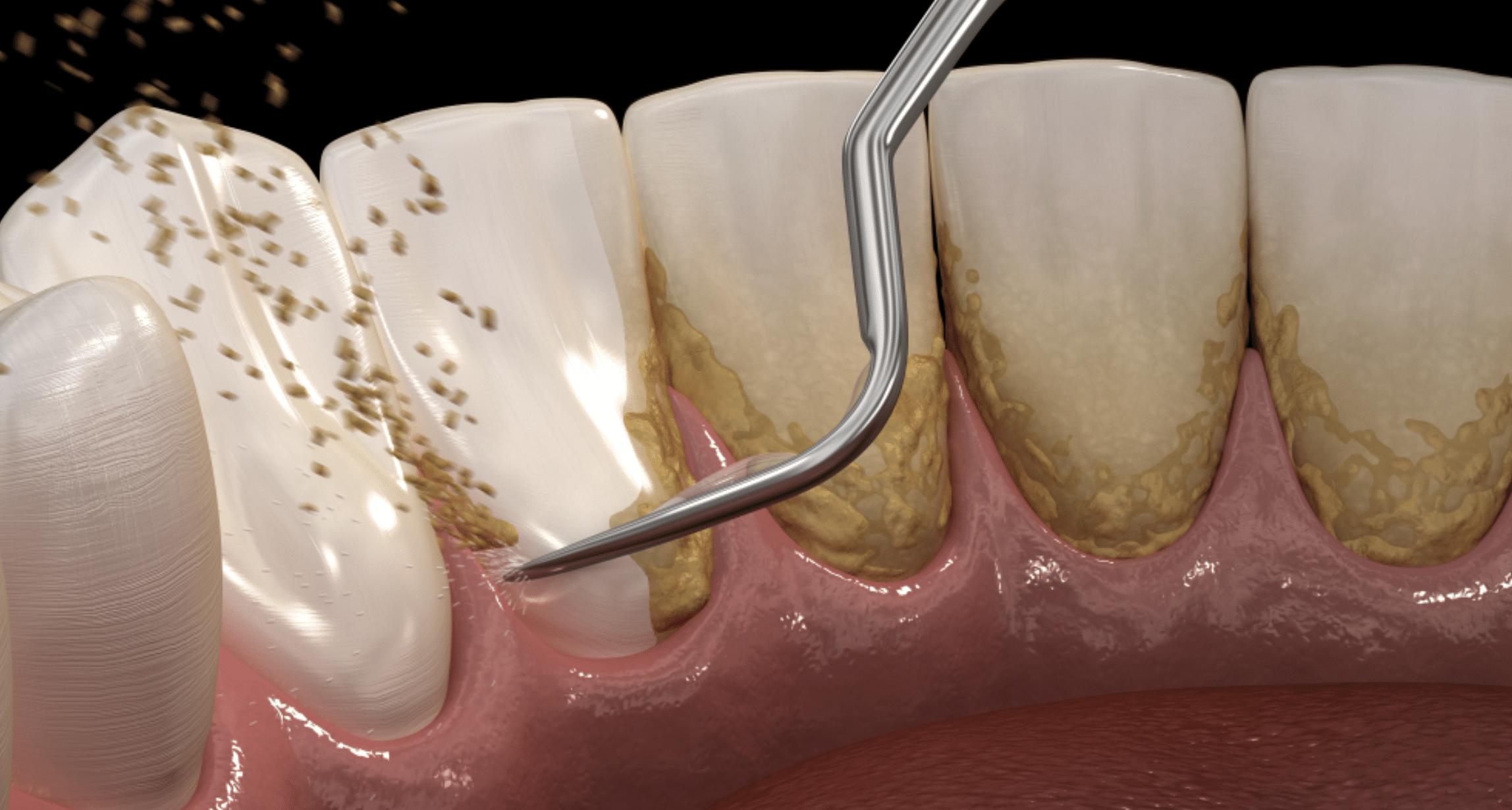 dientes sarro salud bucal