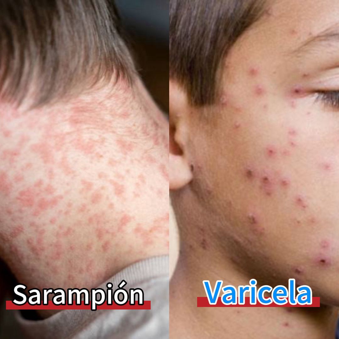 sarampión gobierno del estado slp